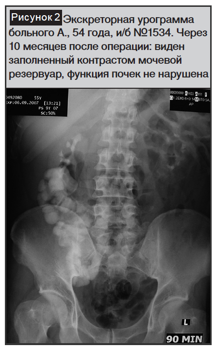 Модифицированный метод деривации мочи после радикальной цистэктомии при ...